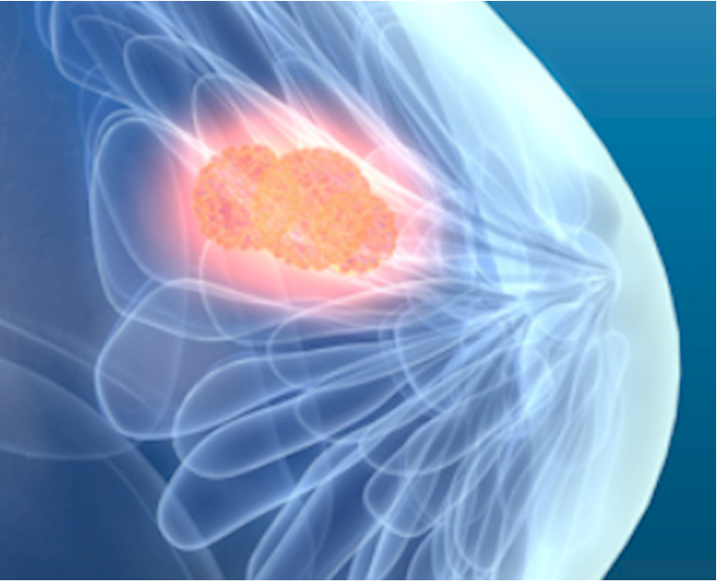 Elastography can help determine breast microcalcifications