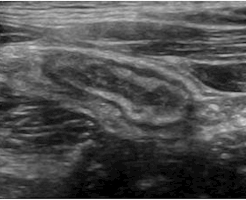 Intestinal ultrasound preferred option to monitor Ulcerative Colitis