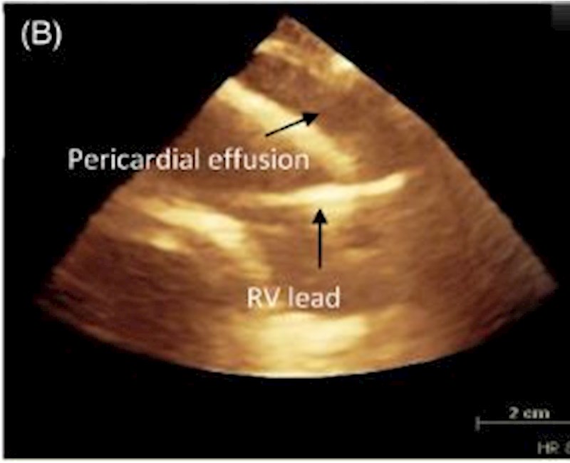 Mis-leading information: A multi-modality approach to an unusual pacemaker lead position